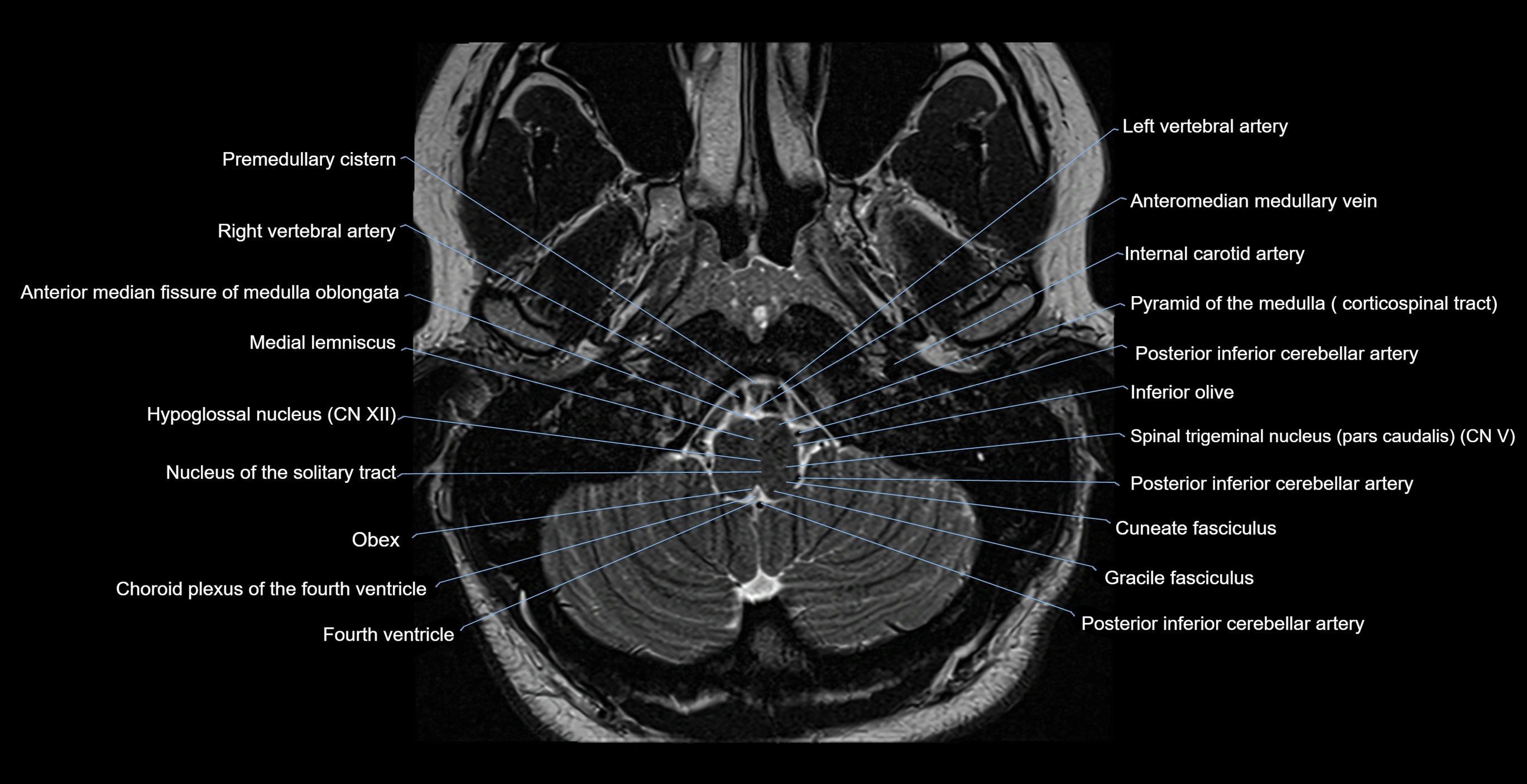 brain axial anatomy 3T MRI images -img-17001-00005.webp